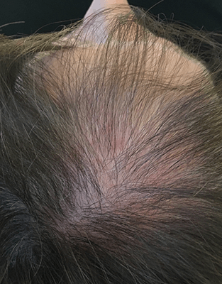 PRP Hair Restoration Results - Before