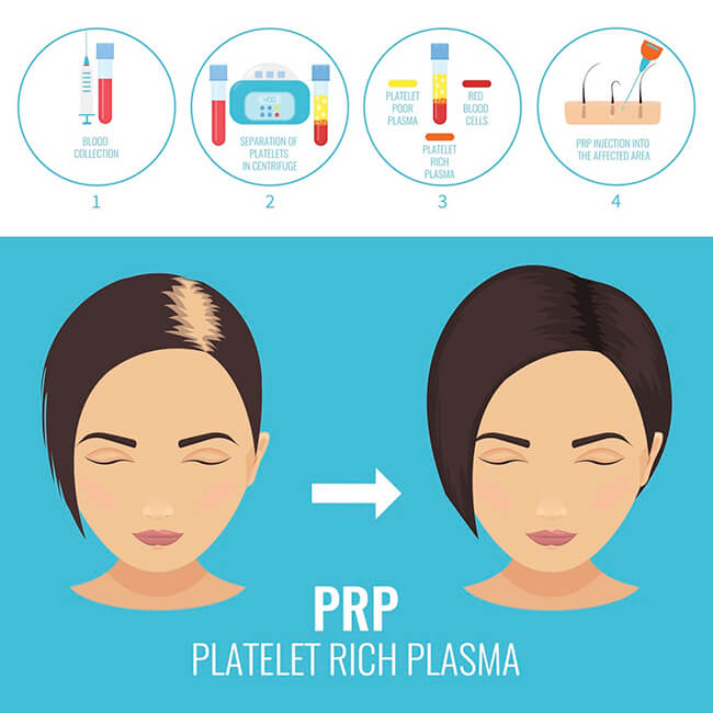 PRP Hair Restoration Porstmouth